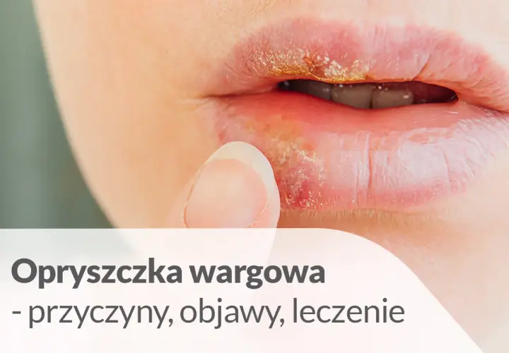 Opryszczka wargowa, jedna z chorób na ustach, objawia się pęcherzykami i strupkami. Palec zbliża się do ust.