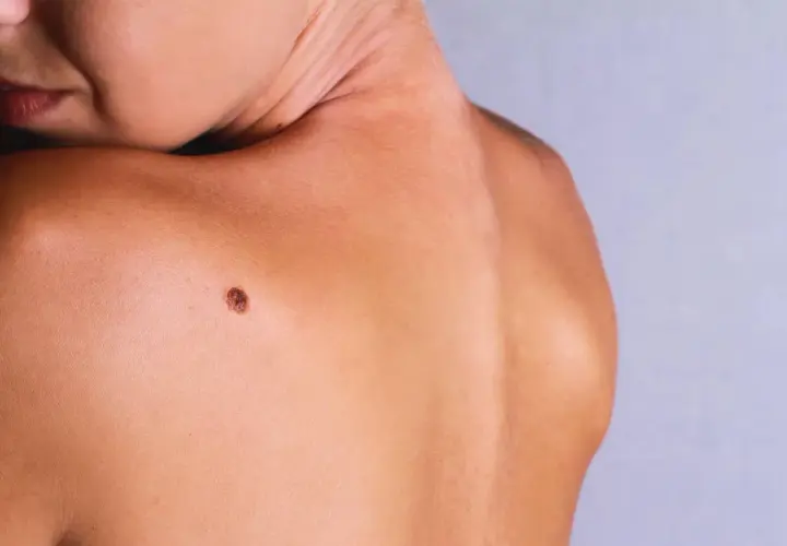 Gros plan sur une épaule et le cou d'une personne, avec un grain de beauté qui dépasse sur la peau bronzée.