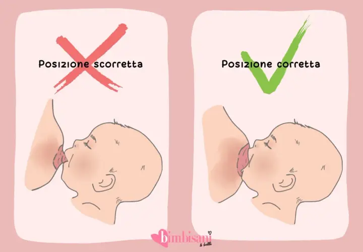 Posizione scorretta vs corretta per allattare, per evitare ragadi al seno.