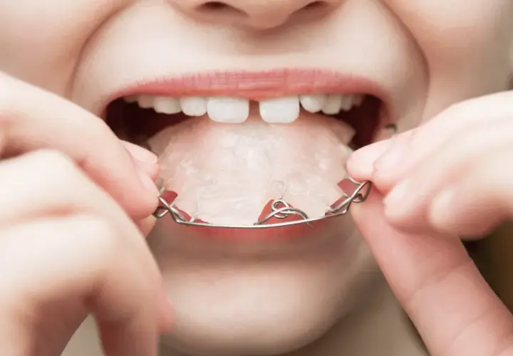 Aparat na zęby dla dziecka: Jak wygląda? Ruchomy, stały, Invisalign