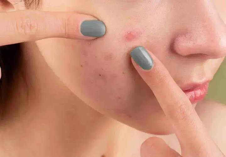 Dita che toccano il viso con acne, un gesto che può peggiorare la dermatillomania come smettere.