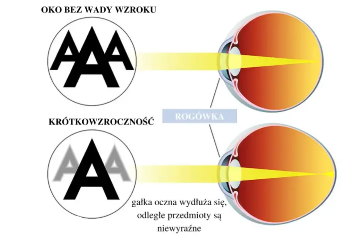 Poznaj wszystkie wady wzroku i ich wpływ na codzienne funkcjonowanie