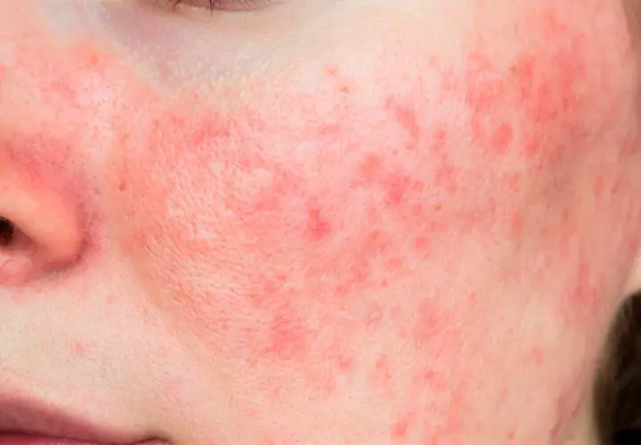 Rostro con enrojecimiento y pequeños bultos, indicativo de rosacea leve.