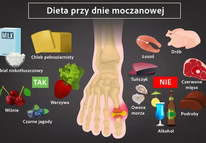 Dieta przy dnie moczanowej: TAK - nabiał, chleb, warzywa, owoce. NIE - drób, ryby, czerwone mięso, podroby, alkohol.