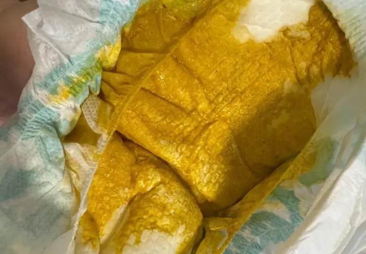 Pannolino con feci gialle e liquide, indicative di diarrea neonato. La consistenza è molto morbida e acquosa.