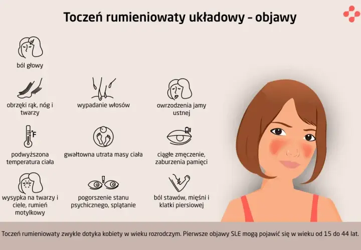 Objawy tocznia: bóle głowy, wysypka motylkowa, wypadanie włosów, owrzodzenia jamy ustnej, obrzęki, gorączka, utrata masy ciała, zmęczenie, problemy z pamięcią, bóle stawów i mięśni.
