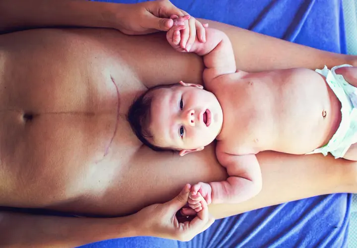 Neugeborenes Baby auf dem Bauch der Mutter, die eine Kaiserschnittnarbe hat. Sanfte Berührung und Heilung durch Osteopathie nach Kaiserschnitt.