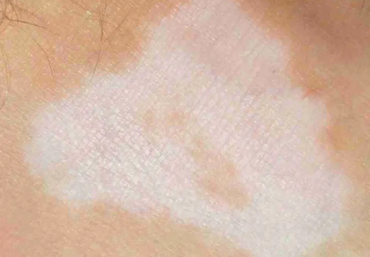 Pelle con macchie bianche e rosa, tipiche del nevo di Sutton nei bambini.