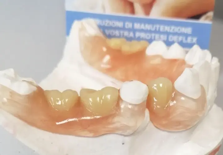Protesi Deflex su modello dentale. Scopri il protesi deflex prezzo per un sorriso perfetto.