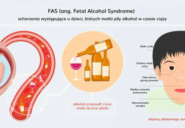 FAS (alkoholowy zespół płodowy) to schorzenie u dzieci, gdy matka piła alkohol w ciąży. Obraz pokazuje płód w macicy, alkohol przechodzący do krwi płodu i cechy twarzy noworodka.