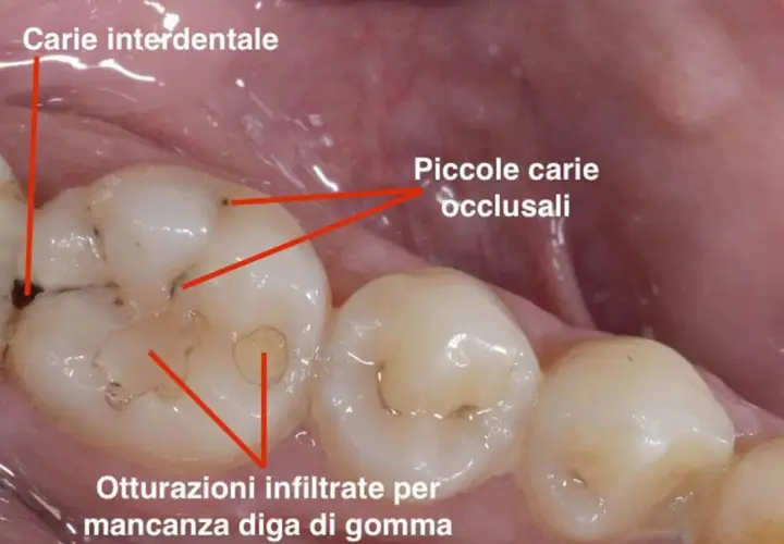 Denti con carie interdentale e occlusale, otturazioni infiltrate. Una situazione che può causare una sgradevole puzza tra i denti.