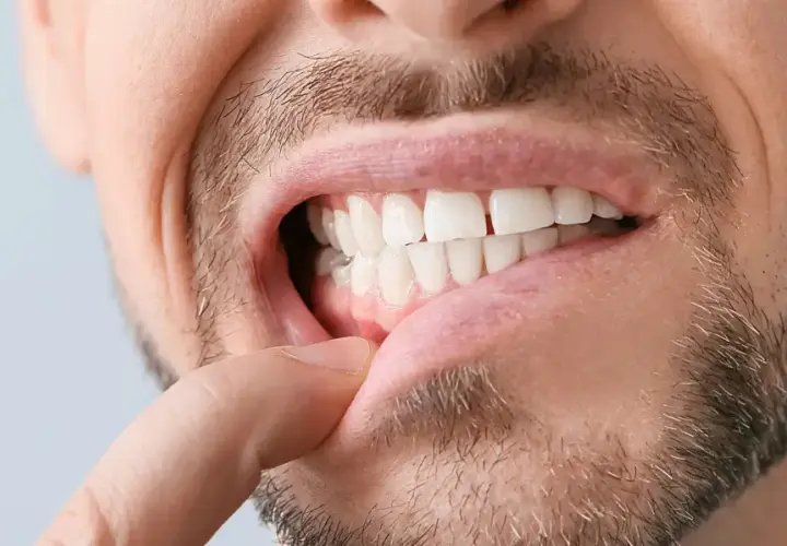 Primo piano di un uomo che mostra i denti e le gengive. Si nota un dito che solleva il labbro, evidenziando le gengive ritirate.