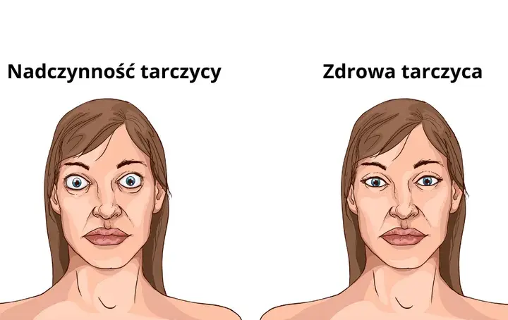 Objawy nadczynności tarczycy u osób starszych - jak je rozpoznać?