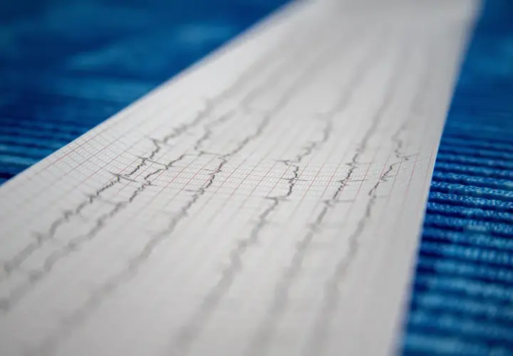 Wynik badania EKG, zapis fal na papierze milimetrowym.