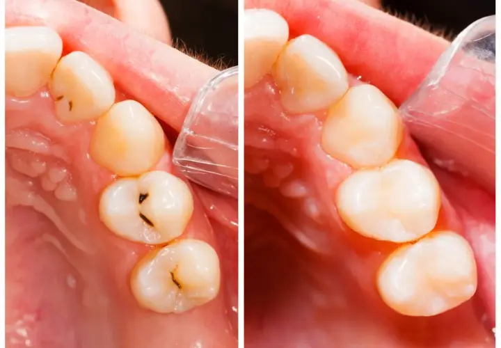 Confronto otturazioni in resina: prima e dopo il trattamento. Scopri quanto durano i denti in resina.