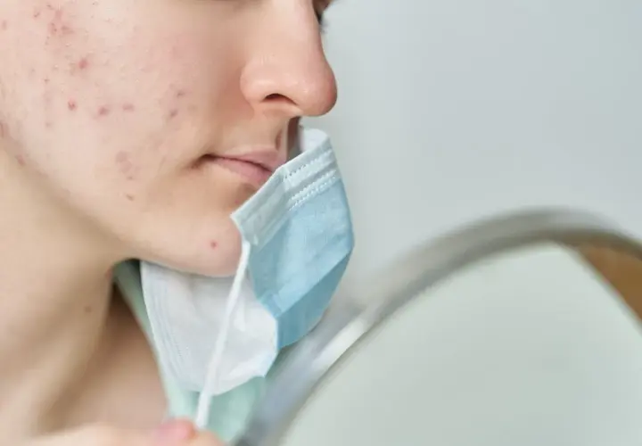 Primo piano di un viso con evidenti segni di acne da mascherina. La persona tiene una mascherina blu e bianca vicino al mento.