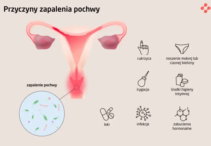 Ilustracja przedstawia przyczyny zapalenia pochwy: cukrzyca, mokra bielizna, irygacja, środki higieny intymnej, leki, infekcje, zaburzenia hormonalne.