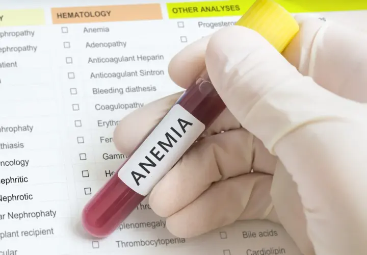 Jakie badania na anemię: Jakie testy są niezbędne do diagnozy?