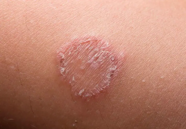 Macchie rosse sulla pelle, un'infezione fungina che forma un anello squamoso.