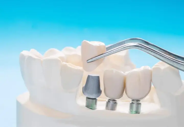 Un dente incapsulato viene posizionato con una pinzetta su un impianto dentale, parte di un modello di mascella.
