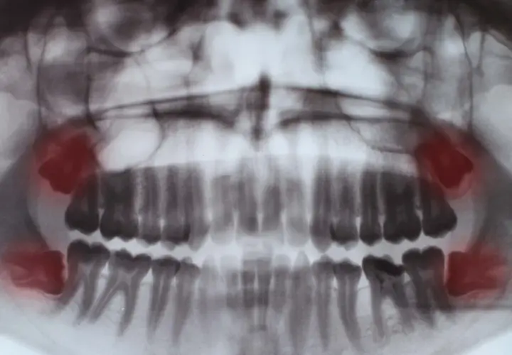 Kiedy rosną zęby mądrości? Objawy, ból i kiedy iść do dentysty