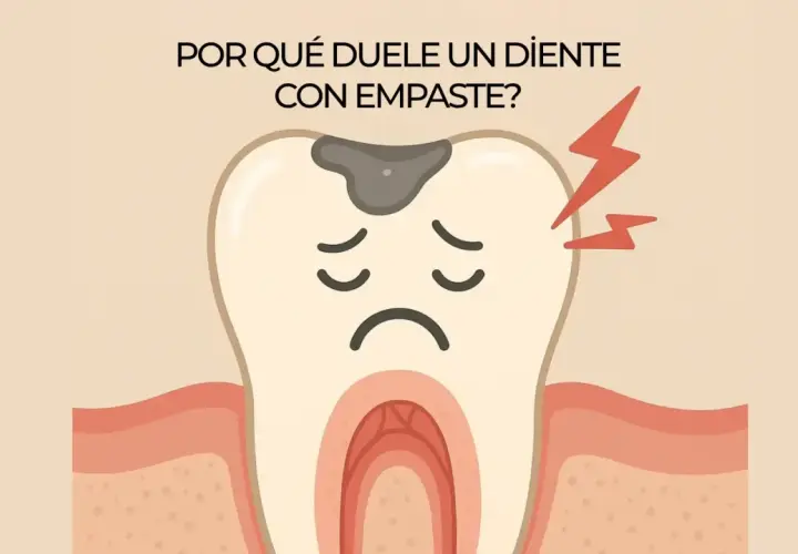 Diente con empaste y caries, con expresión triste y rayos de dolor. ¿Por qué duele una muela empastada al morder?