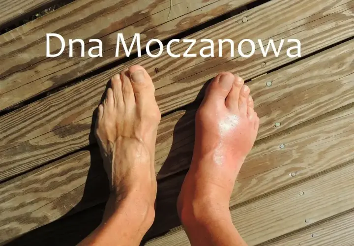 Dwa stopy na drewnianym tarasie. Jedna zdrowa, druga z obrzękiem i zaczerwienieniem, objawem dny moczanowej.