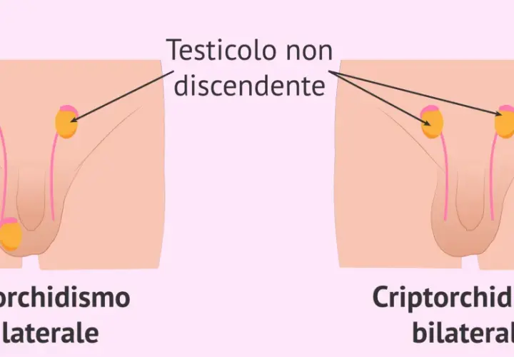 Illustrazione medica che mostra il criptorchidismo, una condizione in cui un testicolo non è sceso. Il testicolo ritenuto bambino 10 anni può essere unilaterale o bilaterale.