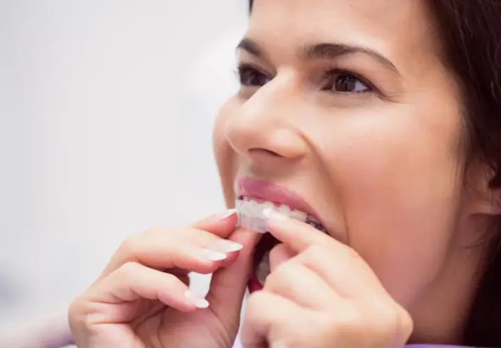 Mujer ajustando su ortodoncia invisible. Un tratamiento que también ayuda a prevenir la periodontitis.