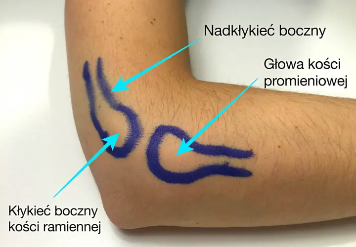 Zaznaczone niebieskim markerem okolice łokcia tenisisty: nadkłykieć boczny, głowa kości promieniowej i kłykieć boczny kości ramiennej.