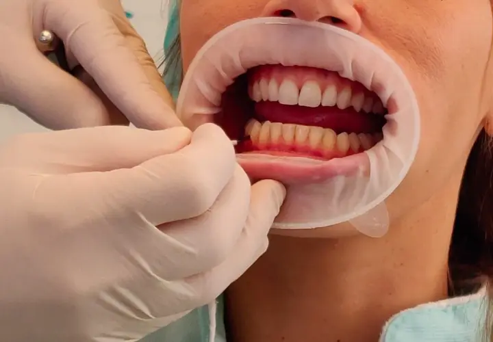 Mani guantate usano scovolini denti per pulire tra i denti di una persona con un divaricatore orale.