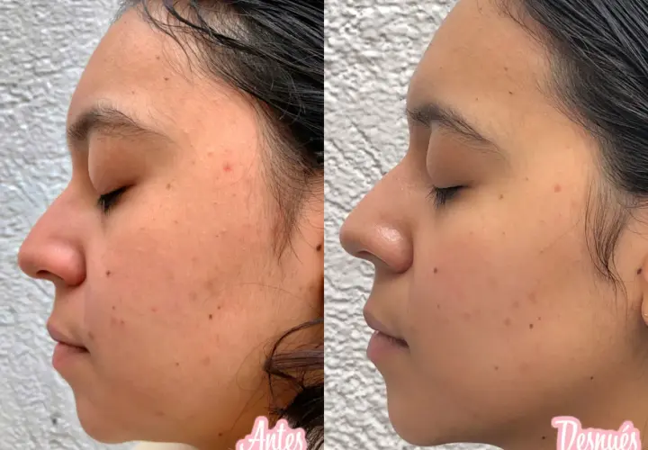 Comparativa de piel con acné y marcas. El lado "antes" muestra imperfecciones, mientras que el "después" revela una piel más lisa tras usar vitaminas para la cara.