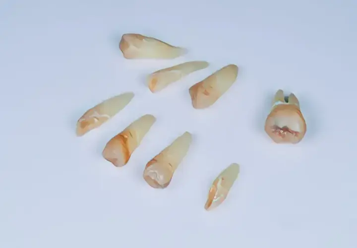 Ból po wyrwaniu ósemki: Jak długo? Kiedy do dentysty?