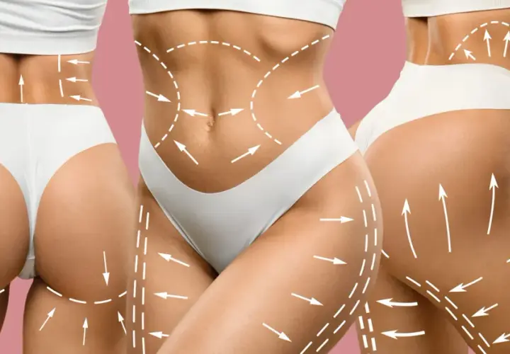 Liposukcja: Co to jest, dla kogo, jak przebiega i ile kosztuje?