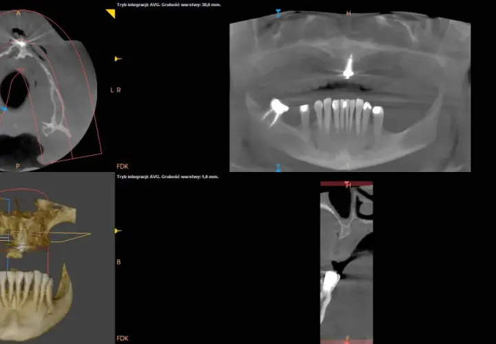 Badanie CBCT pokazuje przekroje zębów i szczęki. To nowoczesna metoda diagnostyki stomatologicznej.