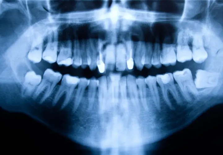 Radiografía panorámica dental que muestra una anomalía ósea, posiblemente un quiste en la boca, afectando la mandíbula inferior.