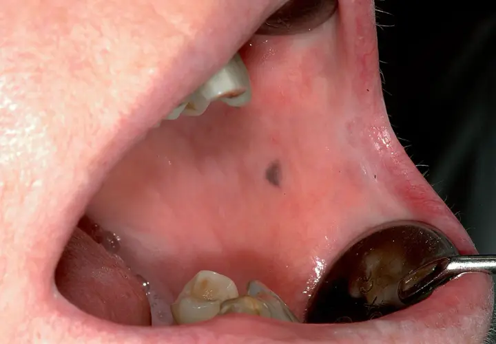 Una macchia scura sul palato, visibile vicino ai denti e a uno specchietto dentale.