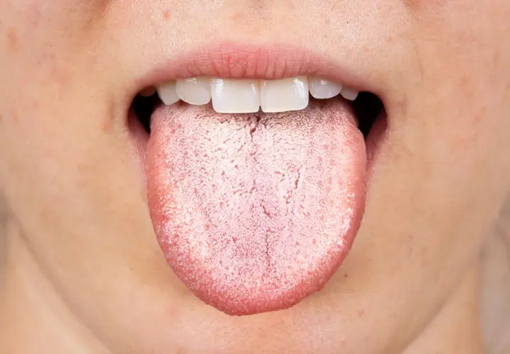 Lingua bianca e ruvida, possibile effetto collaterale di un antibiotico.