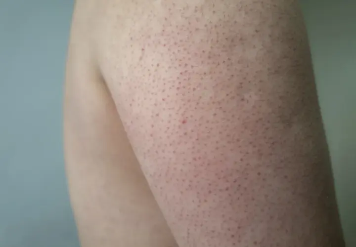 Närbild på en arm med keratosis pilaris hos ett barn. Små röda prickar syns över huden.