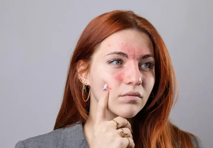 Czerwona wysypka na twarzy młodej kobiety, przypominająca objawy tocznia. Czy toczeń ile się żyje?