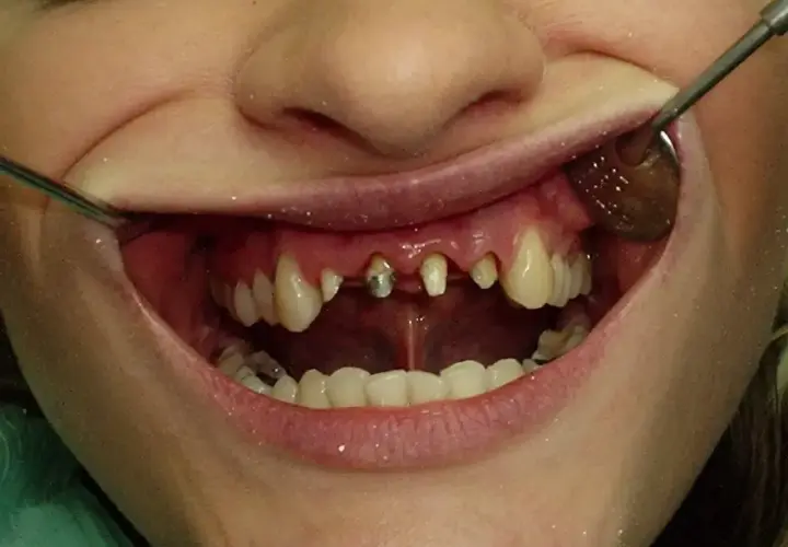 Usta z widocznymi zębami, niektóre wymagają leczenia. Widać fragmenty narzędzi dentystycznych. Planowana jest korona porcelanowa.