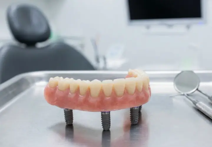 Proteza na implantach, gotowa do montażu. Nowoczesne rozwiązanie dla pełnego uśmiechu.