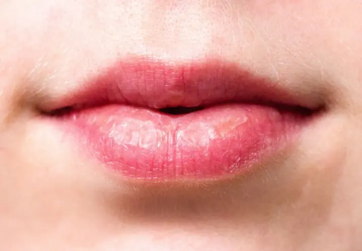 Labios agrietados y secos, con aspecto de labios quemados por el sol, muestran la necesidad de protección.