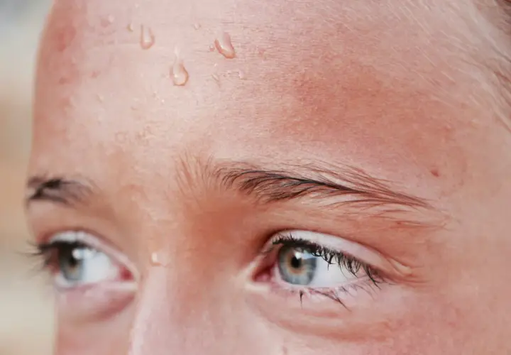 Gotas de sudor en la frente de una persona, un síntoma común de hiperhidrosis facial.