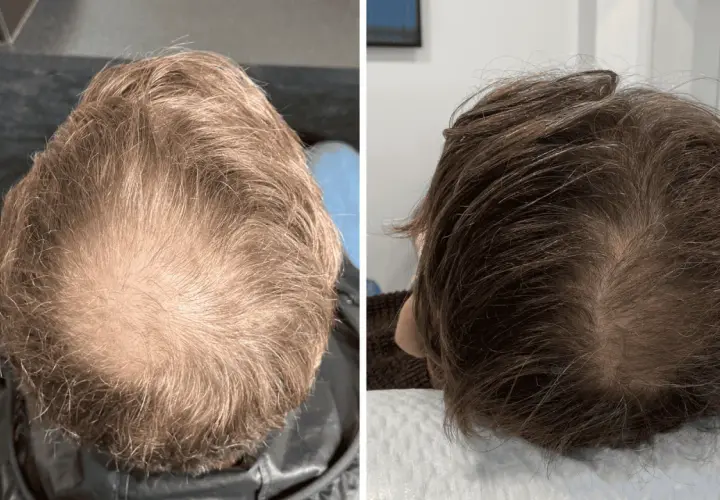 Comparación de la densidad capilar antes y después de la enzimoterapia. Se observa una mejora notable en el crecimiento del cabello.