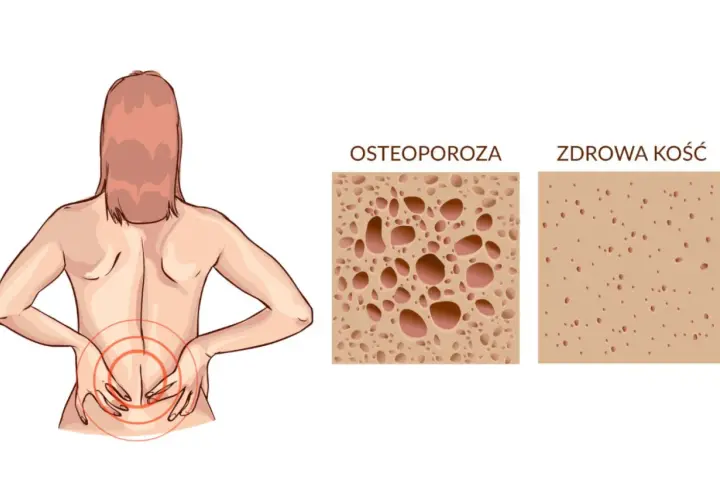 Ból pleców u kobiety z osteoporozą. Porównanie struktury kości: osteoporoza vs zdrowa kość. Czy osteoporoza to rak kości?