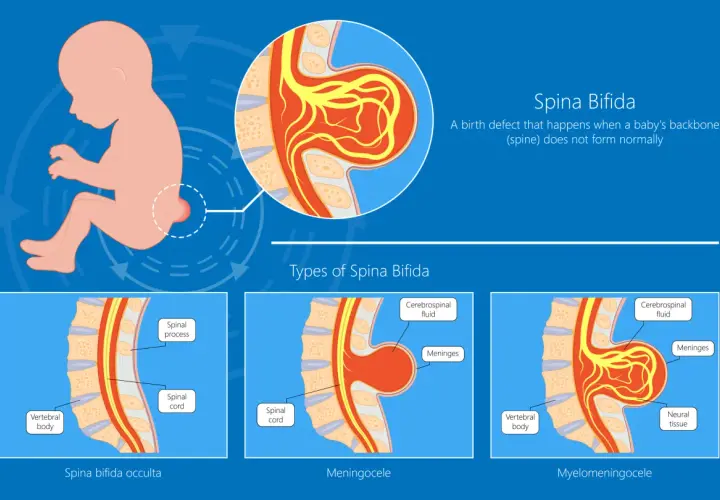 Ilustracja pokazuje wady kręgosłupa u niemowlaka: spina bifida occulta, meningocele i myelomeningocele, gdzie wystający kręgosłup jest widoczny.