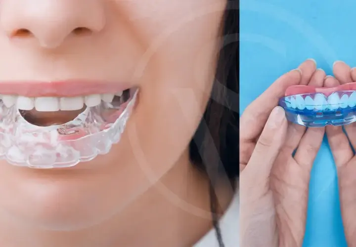 Protector bucal transparente para ayudarte como evitar el bruxismo. En manos, un protector bucal de dos piezas.