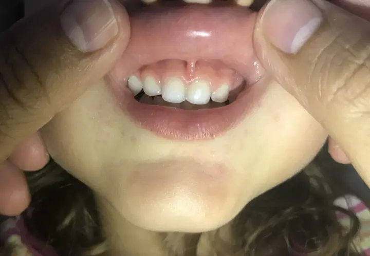 Boca de niño con dientes frontales y el frenillo del labio inferior visible.