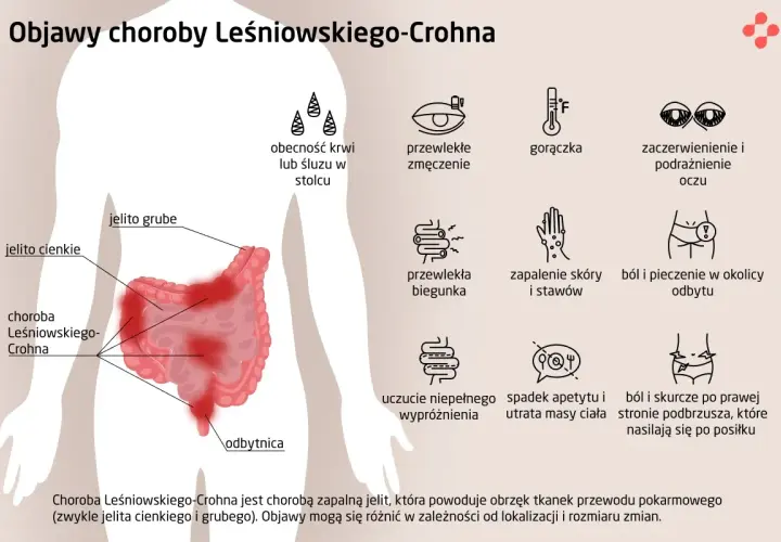 Ilustracja przedstawia objawy choroby Leśniowskiego-Crohna: zmęczenie, gorączkę, biegunkę, ból brzucha, problemy z oczami i skórą.